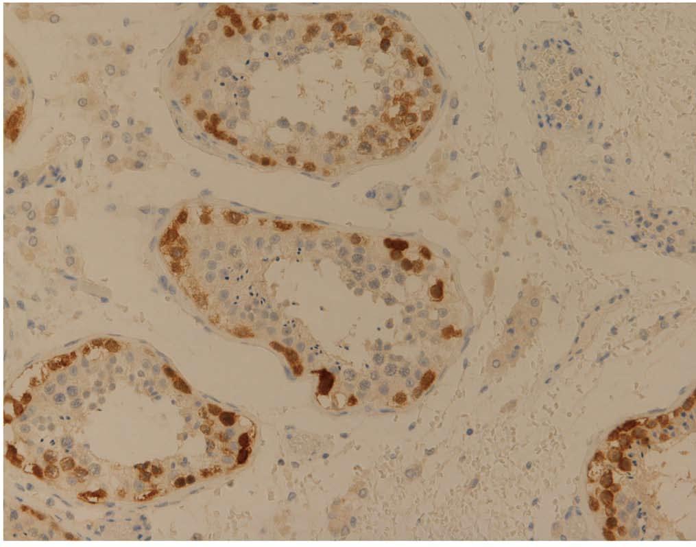 differentiated EAC with apical cytoplasmic dot-type expression for NY- ESO-1 (IHC 60); G: Positive control (testis) demonstrating diffuse NY-ESO-1 expression which is