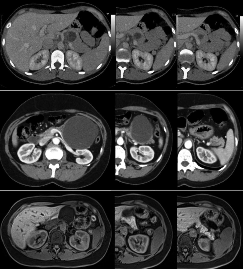 Balzano G et al. Surgical treatment of benign pancreatic neoplasm A B C Figure 1 Abdominal computed tomography scan.