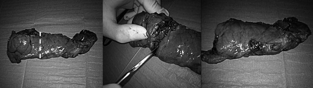 Balzano G et al. Surgical treatment of benign pancreatic neoplasm A B C Cyst Figure 2 Specimen after distal pancreatic resection.