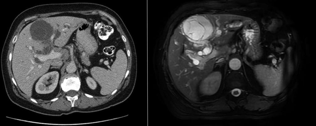 Budzynska A et al. Simultaneous liver MCN and IPMN-B A B Figure 1 Computed tomography scan and T1-weighted magnetic resonance imaging.