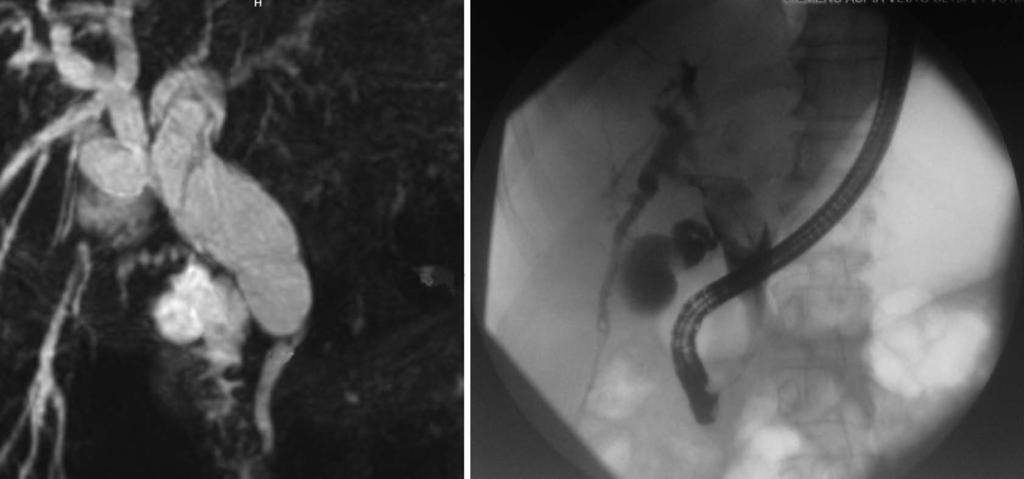 Budzynska A et al. Simultaneous liver MCN and IPMN-B A B 4.9 mm Figure 2 Magnetic resonance and preoperative endoscopic retrograde cholangiopancreatography.