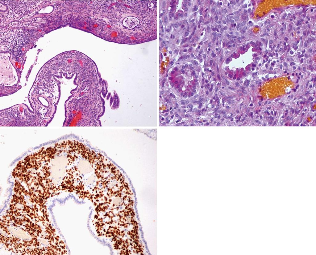 cholangiopancreatography shows marked dilation of the extrahepatic biliary ducts with a contrast-filling defect caused by an oval intraductal tumor. A B C Figure 3 Histology of the intrahepatic tumor.