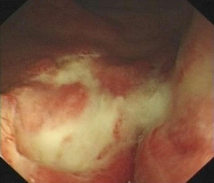 Wang JF et al. Squamous cell carcinoma treatment strategy A B Figure 1 Colonoscopy showing an squamous cell carcinoma of the rectum.