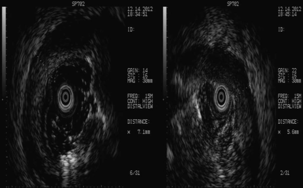 pooling of contrast material (B). A Figure 4 Endoscopic ultrasonography showed ulcers and necrosis in the depth of the mucosa or submucosa (A) and circumscribed mucosal thickening (B).