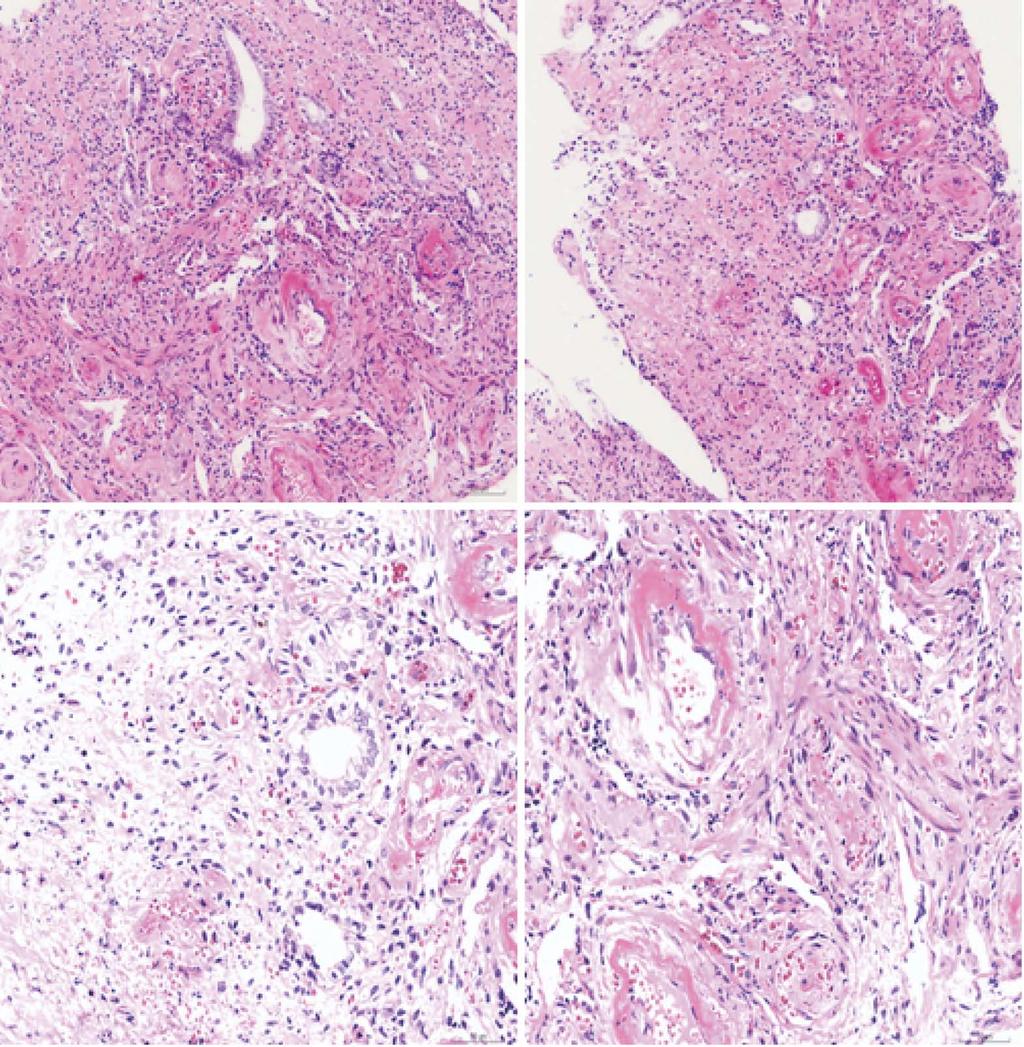 Yang XN et al. Manifestations of Behçet's disease A B Figure 5 Sigmoid colon mucosal biopsy revealed chronic nonspecific colitis (A, B: HE stain, 100 ; C, D: HE stain, 200 ).