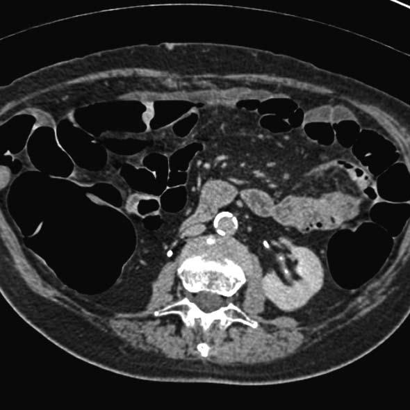 Chest and abdominal CT is recommended for the preoperative staging of CRC by the European Society of Medical Oncology [3] and by the American