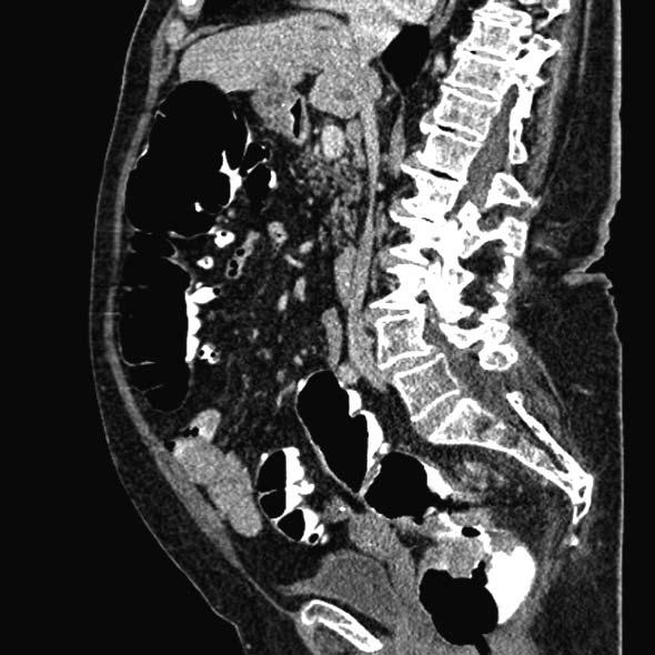 Sali L et al. Preoperative CTC in colorectal cancer A B Figure 6 Computed tomography colonography of T3 M1 rectal cancer.