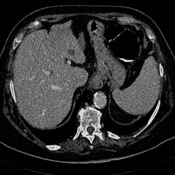 metastatic lesion is located in the third hepatic segment (arrowhead). A B Figure 7 Computed tomography colonography of a T3 M1 stenosing Computed tomography colonography of the transverse colon.