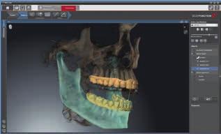 Thanks to the highly precise recording of all degrees of freedom and movements of the mandible with the SICAT JMT+, you can now transfer, visualize, and diagnose anatomically correct jaw movement