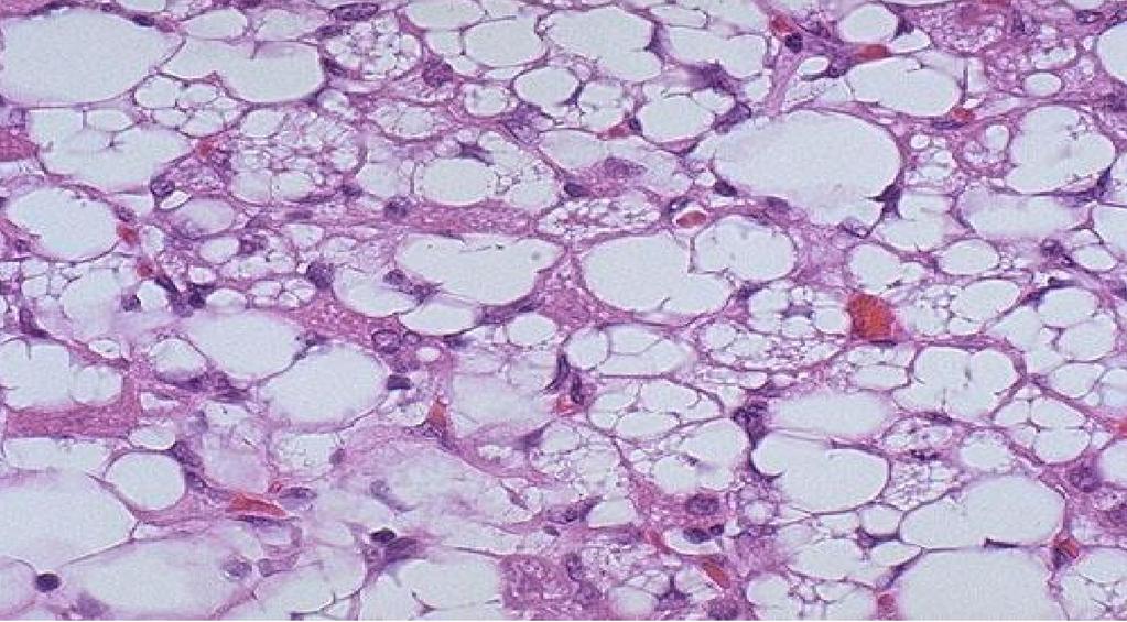 Anaplasia: Malignant neoplasms that are composed of undifferentiated cells are said to be anaplastic. Lack of differentiation, or anaplasia, is considered a hallmark of malignancy.
