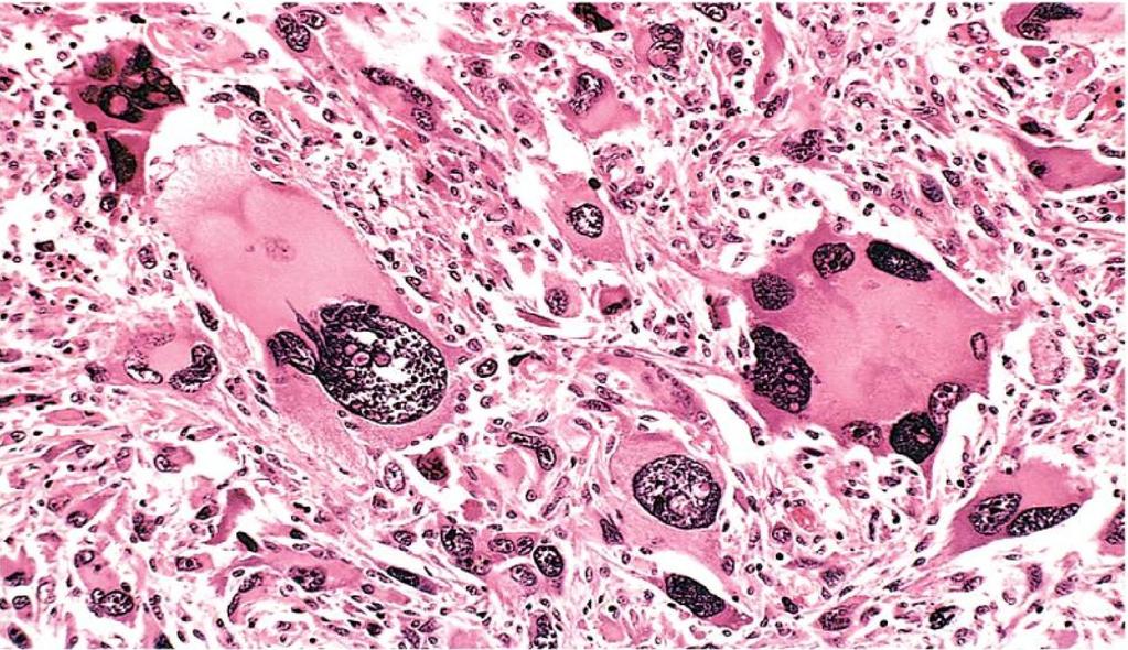 9-Cells may grow in sheets with total loss of communal structures such as gland formations or stratified squamous architecture. Anaplasia Multi nuclear cells, varying sizes,unknown origin.