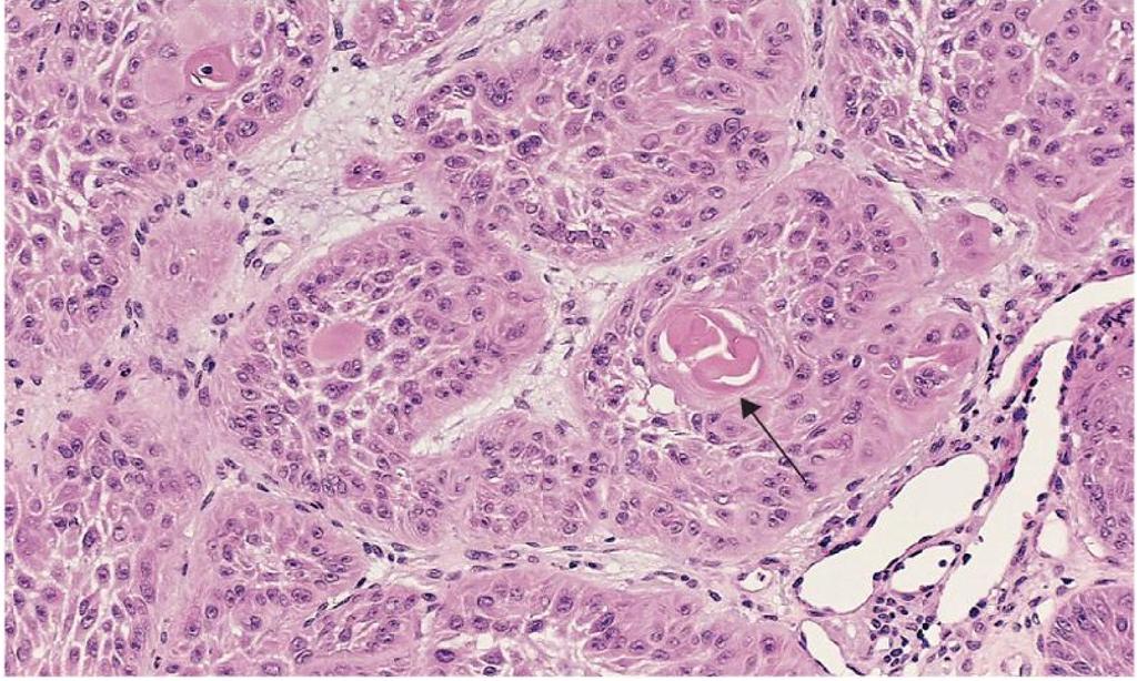 Normal colonic mucosa (left) vs adenoma (right) The nuclei of the glandular cells in adenoma are