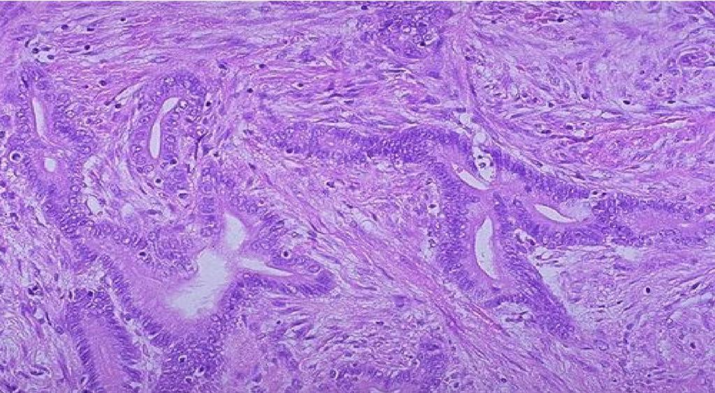 Moderately differentiated adenocarcinoma In adenocarcinoma the glands are disorganized and somehow overlapping.