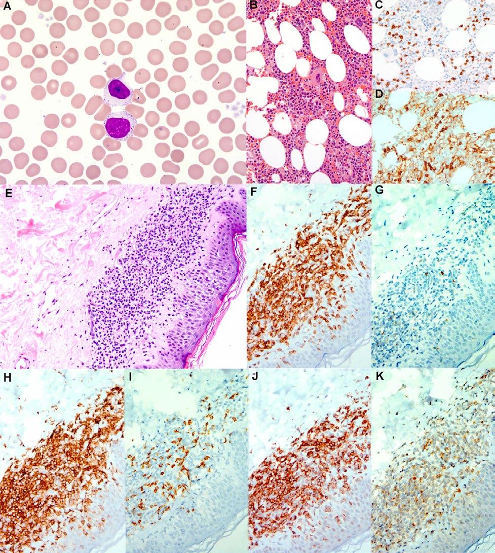 A B C D E F G H I J K Fig 2A K. (A) Peripheral blood smear showed many circulating T-cell large granular lymphocytes containing azurophilic cytotoxic granules (Wright stain, 100).