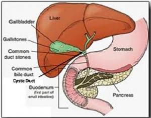 This leaflet will give you some useful information about gallstones, their effects on you, options of treatment and alternatives, the benefits of surgery, what it involves and what the common
