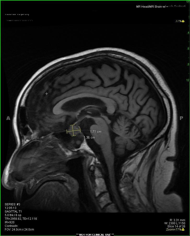 579 Figure 1: MRI Head Post-Contrast T1