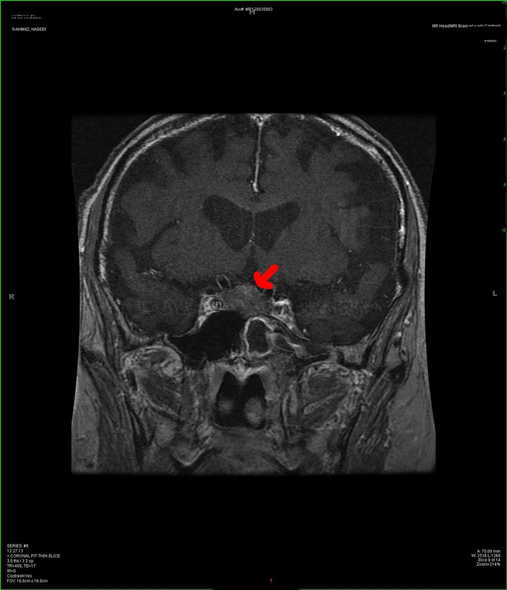 580 Figure 2: MRI Head Post-Contrast T1 Coronal