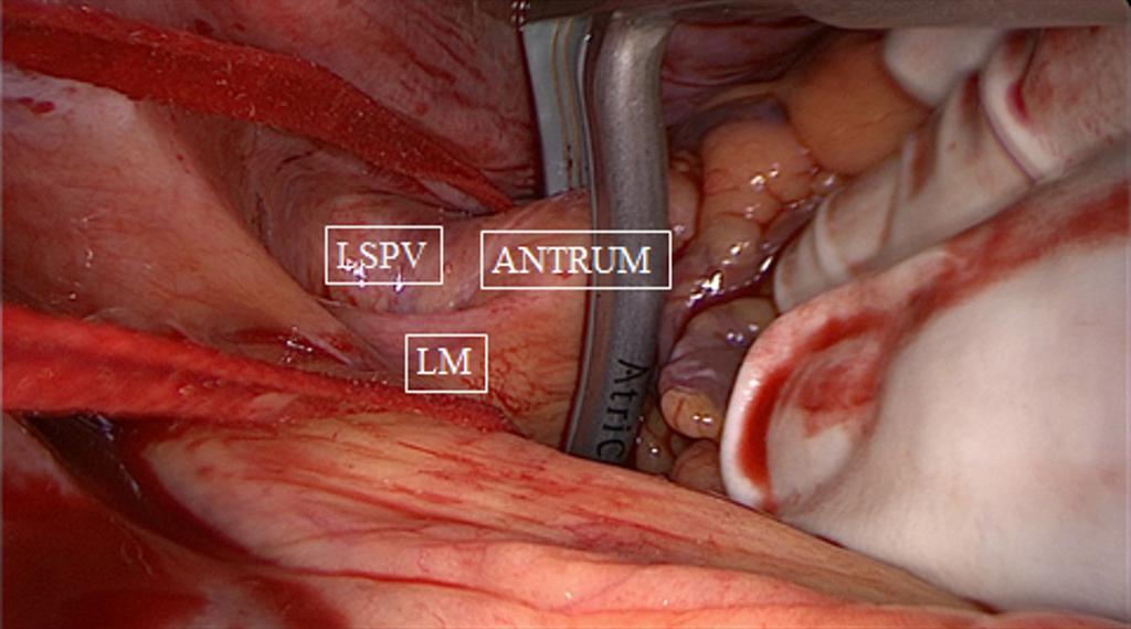 Arrow points to antral ablation line of right PVs. SVC, superior caval vein; IVC, inferior caval vein; PVs, pulmonary veins.