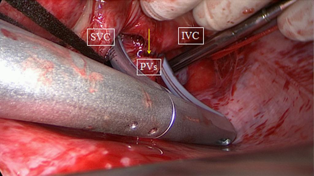 aorta and pulmonary trunk anteriorly, and the venous mesocardium, which covers the SVC, left atrium and PVs posteriorly and inferiorly. The right PVs are then accessed.