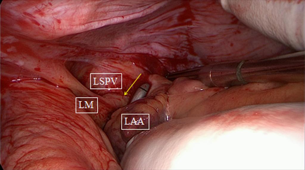 128 La Meir et al. Concomitant atrial fibrillation in non-mitral valve surgery clamped distal to the opening into the right atrium to avoid the sinus node.