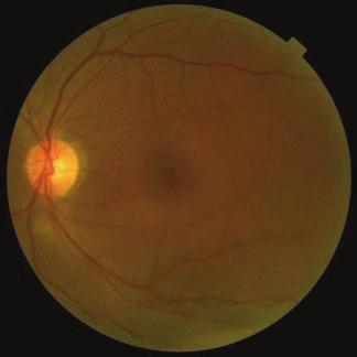 Ophthalmology 5 (a) (b) Figure 3: Representative eyes with good and poor visual outcomes after surgery for macula-off rhegmatogenous retinal detachment.