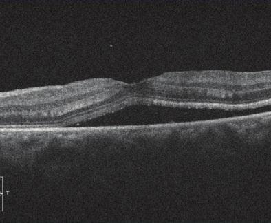 3) with a poor visual outcome (postoperative decimal visual acuity: 0.3). Preoperative photographs of the fundus, preoperative optical coherence tomography (OCT) images, and postoperative OCT images are shown on the left, center, and right, respectively.