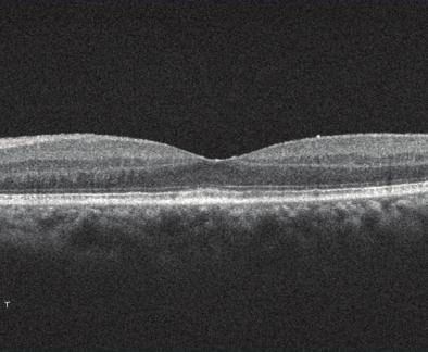 A circular area larger than 2 mm would begintolosereliability,asitwouldbemoreinfluencedby intraretinal edema, bending, or severe undulation of the detachment.
