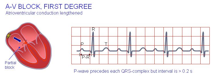 Delay at AV-node: AV node blocks First-degree atrioventricular block When the P-wave always