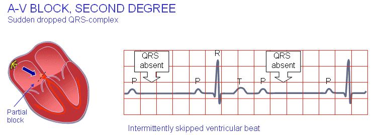 2 s, first-degree atrioventricular block is diagnosed.