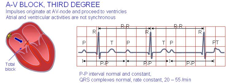 Third-degree atrioventricular block Complete lack of synchronism between the P-wave and the QRS-complex is diagnosed as third-degree (or total) atrioventricular block.