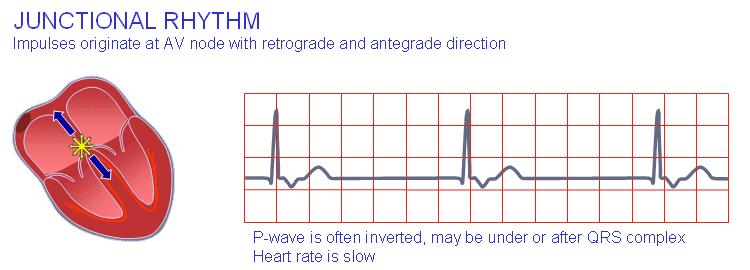 One last weird one: Heart rhythms starting at AV node Junctional rhythm The heart rate should usually start at the SA node (this is called a sinus rhythm).