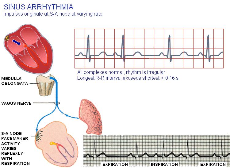 Respiratory Sinus Arrythmia Respiratory sinus arrhythmia (RSA) is a naturally occurring variation in heart rate that occurs during a breathing cycle.