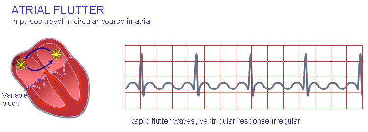 Atrial flutter When the heart rate is sufficiently elevated so that the isoelectric interval between the end of T and beginning of P disappears, the arrhythmia is called atrial flutter.