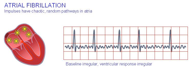 The AV-node and, thereafter, the ventricles are generally activated by every second or every third atrial impulse (for example: 1 QRS is preceded by 2, or 3, p-waves.
