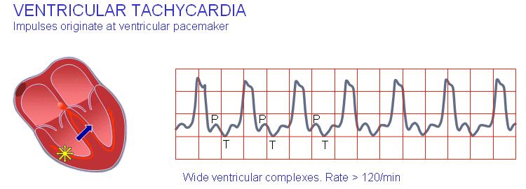 Ventricular tachycardia Increased rate of ventricular contraction due to ectopic focus in the ventricle.
