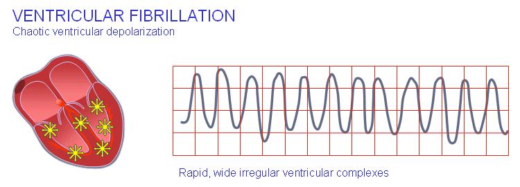 Ventricular fibrillation When ventricular depolarization occurs chaotically, the situation is called ventricular fibrillation.