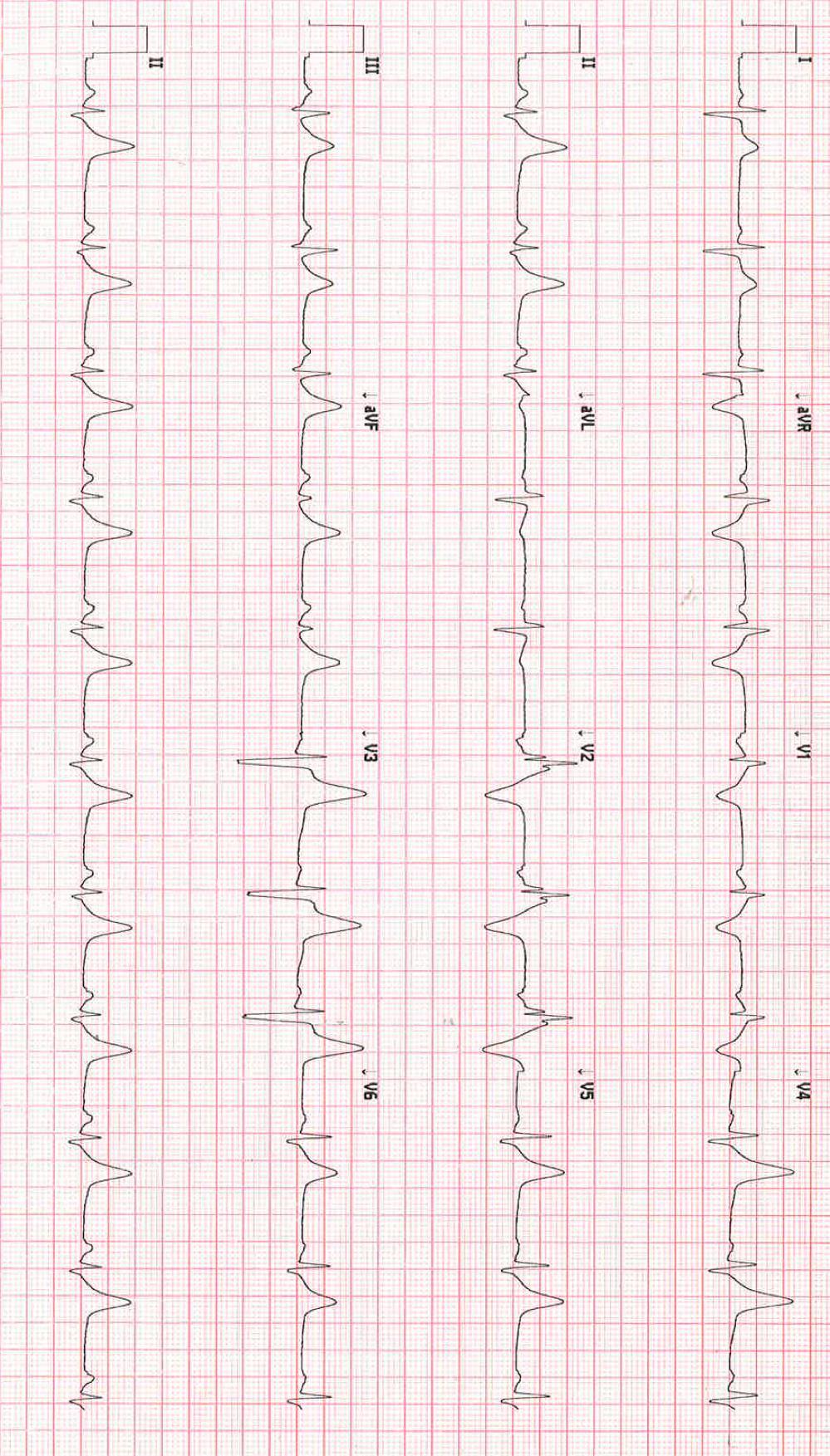 ECG 6 41 yr old male resuscitated from VF next step?