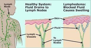 The Lymphatic System Some diseases of the lymphatic