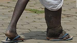 Some lymphatic diseases and disorders Lymphedema- Elephantiasis is a condition characterized by gross enlargement of an area of the