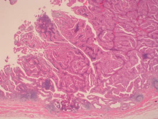 Clinicopathological Study of Gallbladder Cancer 37 Fig. 1. Microscopic features of mass-forming gallbladder cancer. a-1 Intraluminal mass consists extensively of low-grade dysplastic glands.