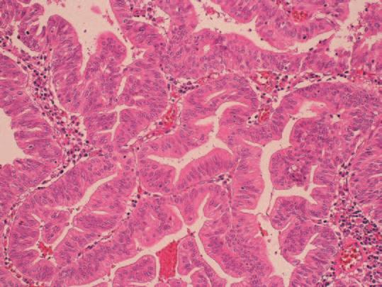 b-1 Intraluminal mass consists extensively of high-grade dysplastic glands. H E stain, 50 magnification. b-2 Intraluminal mass consists extensively of high-grade dysplastic glands.