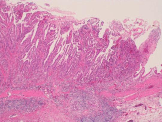 Investigation of cell lineage The cell lineage of the neoplastic glands composing the mass lesion was investigated histomorphologically and immunohistochemically for all cases.