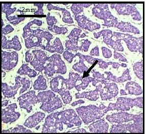 singles (Pap, 4x) Inset Mild Pleomorphic tumour cells with