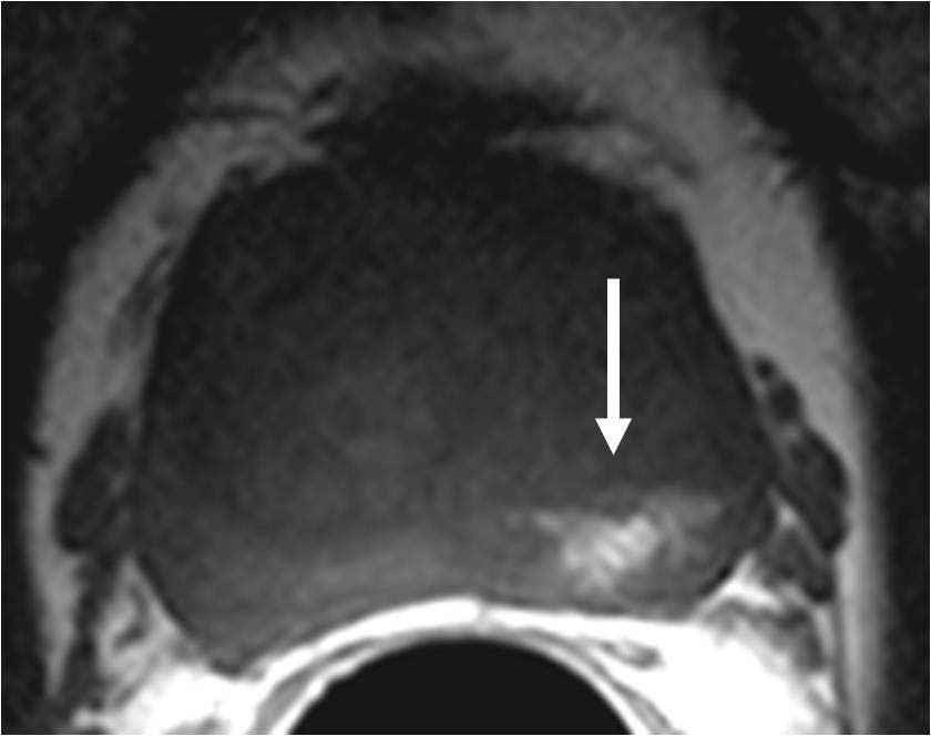 Imging Assessment of Primry Prostte Cncer, Focused on Advnced MR Imging nd PET/CT T1-weighted imges (TR 400-500, TE 10-15), () xil, sgittl nd coronl spin echo or fst spin echo T2- weighted imges (TR