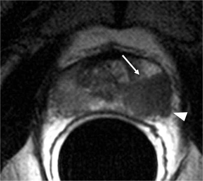 Jin Hee Jng et l Fig. 4. Extrcpsulr invsion An ovoid hypointense nodule (rrow) is seen in right peripherl zone on xil T2-weighted imge.