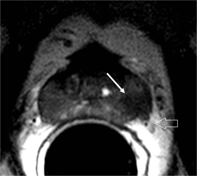 Findings re comptile with prostte cncer in right peripherl zone with extrcpsulr invsion. Prostte cncer with extrcpsulr invsion (T3, Gleson s score 6)