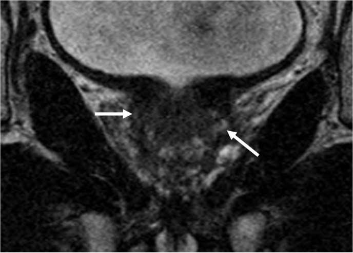 of enign denom, [d] olitertion of surgicl pseudocpsule (trnsition zone-to-peripherl zone oundry of low SI), [e] urethrl or nterior firomusculr stroml invsion, [f] lenticulr-shped lesion (14).
