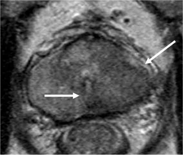 Imging Assessment of Primry Prostte Cncer, Focused on Advnced MR Imging nd PET/CT ADC vlues is nother fctor for the ADC vlues (22-25).