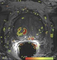 Dynamic Contrast-Enhanced MRI In prostate cancer, increased tumor vascularity leads to early hyperenhancement and rapid washout of contrast material.