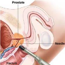 Transperineal approach improves access but is seldom used this is attributed to men not liking needles stabbed in their perineum?